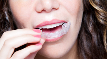 Invisalign